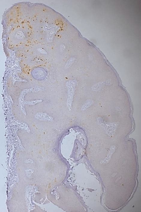 Histopathological Examination Revealed Parakeratosis Acanthosis