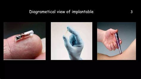 Implantable Drug Delivery System Pptx