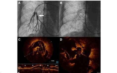 A Initial Selective Right Pulmonary Artery Angiography With