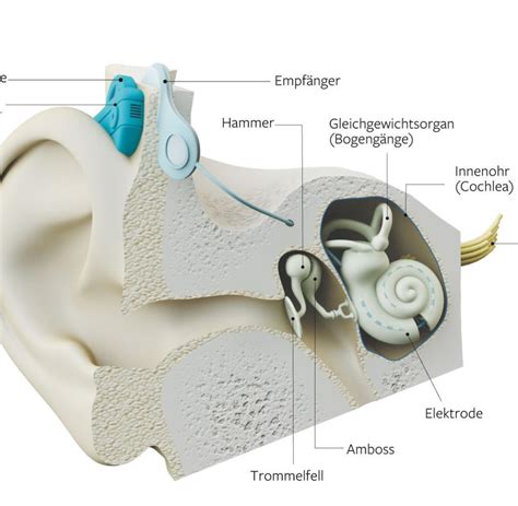 Cochlea Implantat Diese Prothese macht Gehörlose zu Hörenden WELT