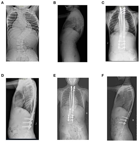 Frontiers Efficacy Of The Growing Rod Technique On Kyphotic Early