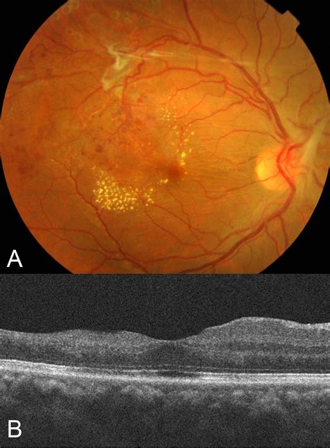 Retinal Vasculitis Retina Associates