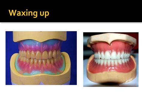 Complete Denture Prosthodontics Step By Step Ppt