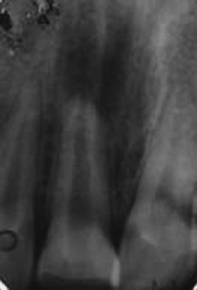 Periapical Radiograph Showing Incomplete Root End Development And