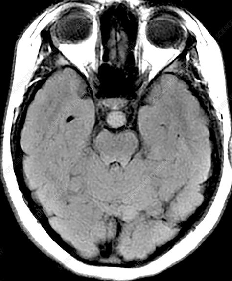 Hypothalamic Hamartoma Mri Stock Image C Science Photo