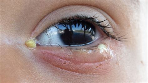 Eye Discharge Causes Associated Conditions And Treatments 1md