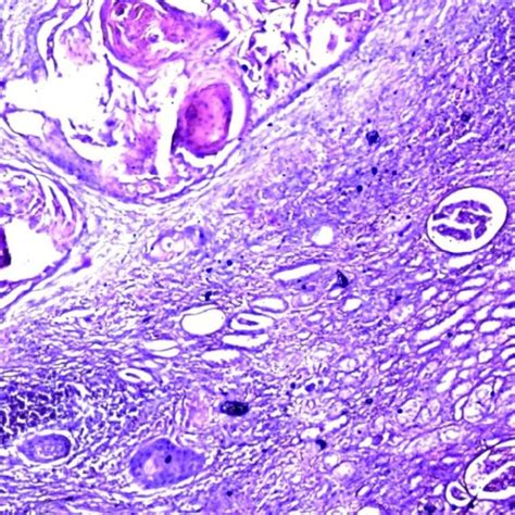 Microscopic Appearance Of Esophageal Squamous Cell Carcinoma Metastases