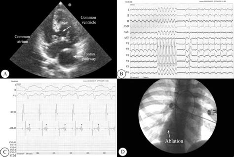 A Two Dimensional Echocardiographic Image Depicting The Straddling