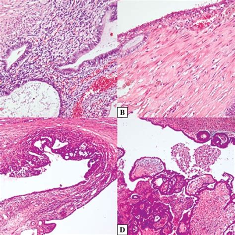 Targeted therapy in endometriosis and endometriosis-associated ovarian ...