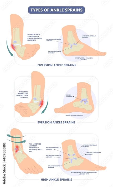 Injury Talo Fibular Foot Treat High Low Roll Twist Tear Tough Bands