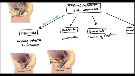 Uterine Prolapse And Vaginal Prolapse For Usmle Youtube