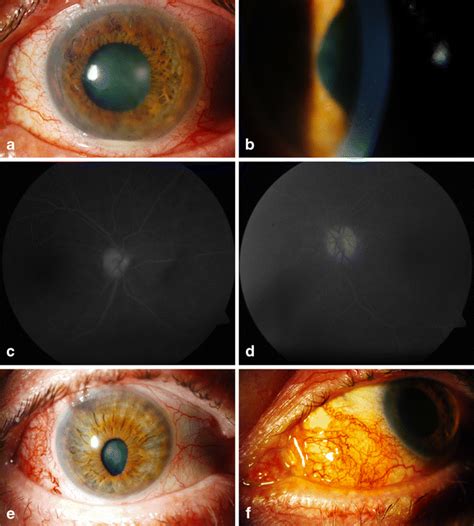 Celecoxib For Recurrent Sclerouveitis After Syphilitic Panuveitis A