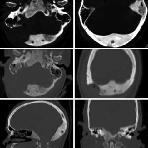 Computed Tomography Head Bone Windows Delineating The Involved