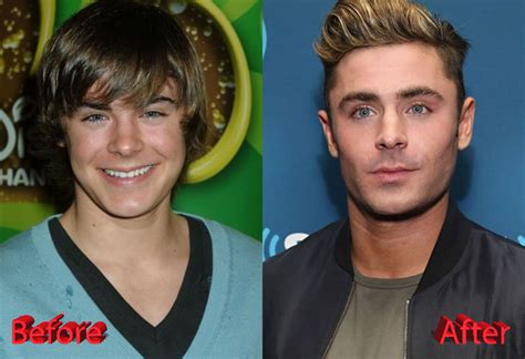 Zac Efron Plastic Surgery A New Look For Teen Heartthrob