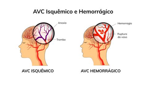 Avc Quais Os Principais Sintomas E Fatores De Risco