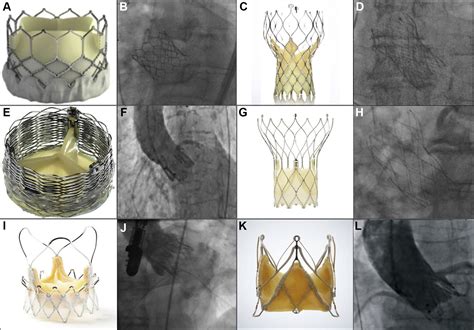 Latest Generation Transcatheter Aortic Valve Replacement Devices And