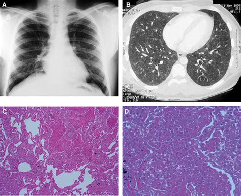 Tropical Pulmonary Eosinophilia A Rare Cause Of Cough In Immigrants To