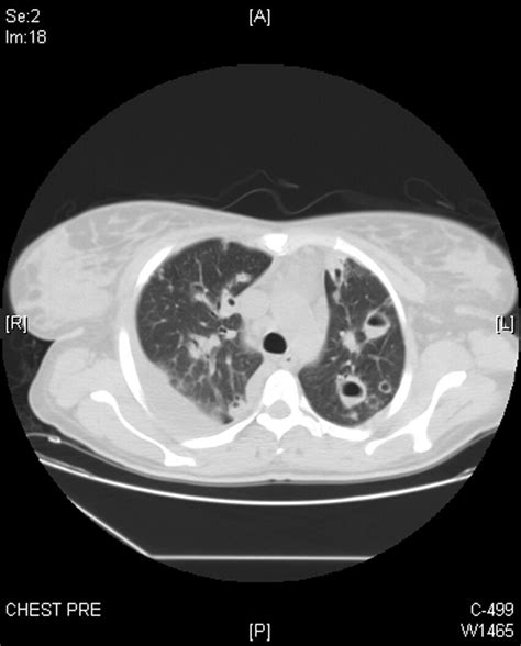 Chest Computed Tomography Scan In A Patient With Septic Pulmonary Download Scientific Diagram