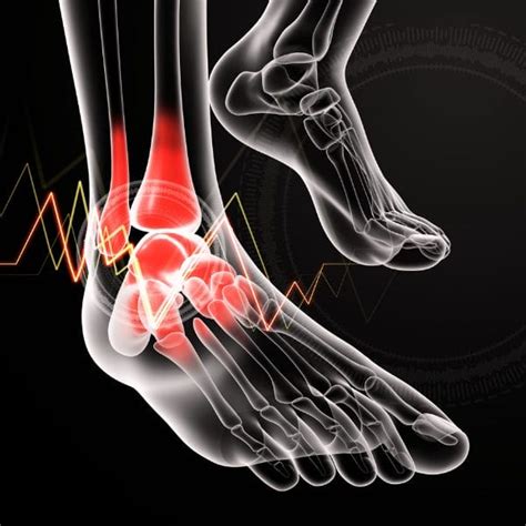 Cuboid Syndrome: Causes, Symptoms, Diagnosis & Treatment