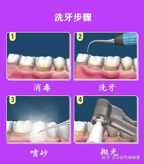 科普洗牙的最全步骤 知乎