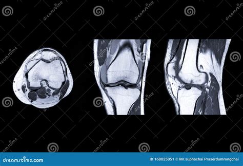 Mri Knee Joint Or Magnetic Resonance Imaging Compare Axial Coronal And