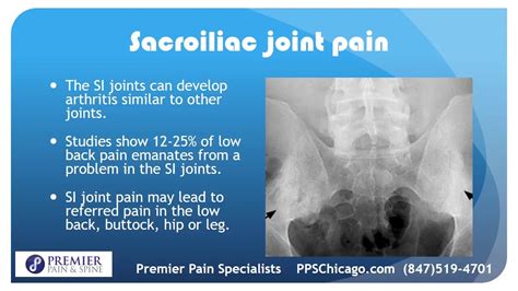 Si Joint Injection Explained By A Top Chicago Pain Management Center