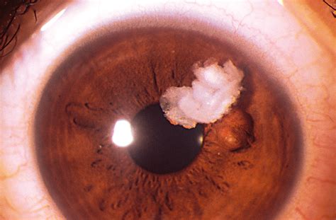 Free Keratin And Dermoid Cyst Of The Iris Dermatology Jama