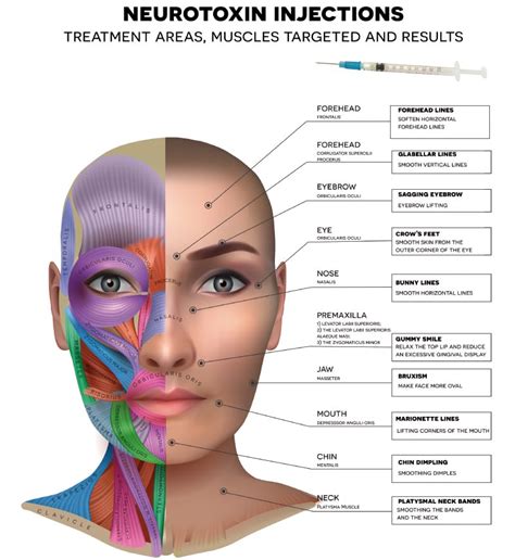 Diagram Botox Lip Flip Injection Points Diagram Botox Lip Fl