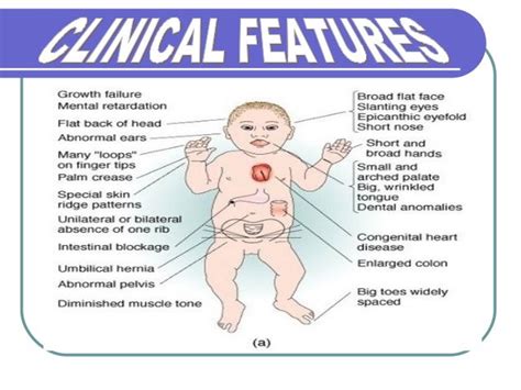 craniofacial anomalies down , apert's and gorlin goltz syndrome