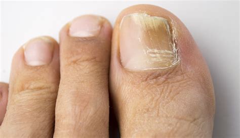 Laser Therapy For Onychomycosis Of The Toenails Clinical Advisor