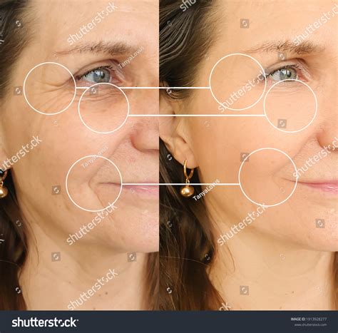 Woman Face Wrinkles Before After Treatment Stock Photo