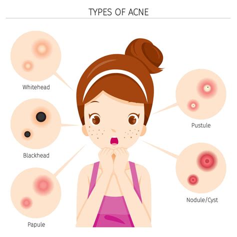 Acne: development and stages - Lotus Flower PCOS