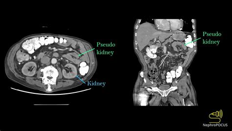 NephroPOCUS On Twitter Answer Bowel Loop Mimicking Kidney In The