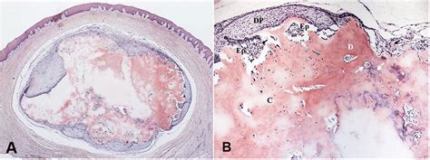 Photomicrograph Of The Excisional Biopsy Showing In A A Tumor Composed