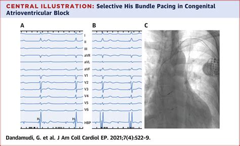 Permanent His Bundle Pacing In Patients With Congenital Complete Heart