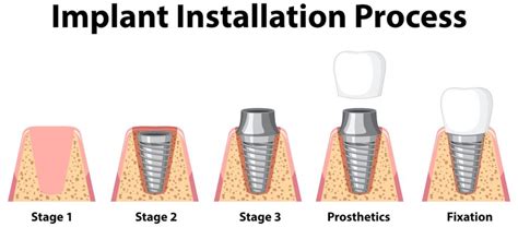 How Painful Is Getting A Dental Implant Sola Dental Spa