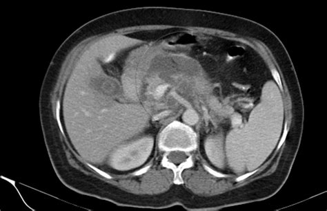 Necrotizing Pancreatitis Image Radiopaedia Org