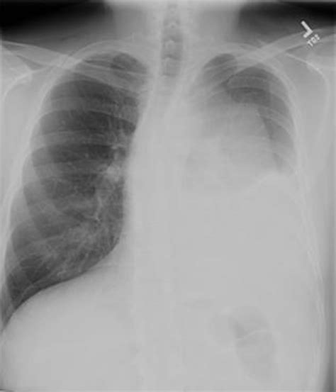 Surgical Management Of Primary Mediastinal Germ Cell Tumors Ctsnet