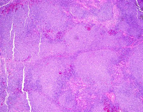 Pathology Outlines Unusual Morphologic Patterns Of Follicular Lymphoma