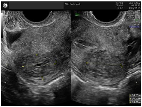 Medicina Free Full Text Uterine Tumors Resembling Ovarian Sex Cord