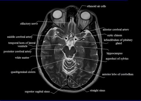 Mri Anatomy Free Mri Axial Brain Anatomy