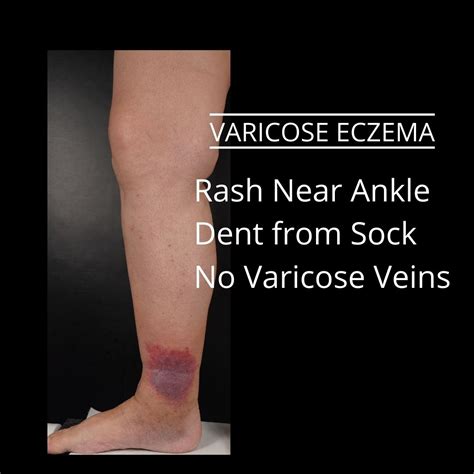 Is Varicose Eczema Curable The VeinCare Centre