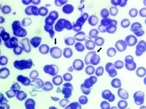 Giemsa stain (×1000) peripheral smear showing macrocytic normochromic ...