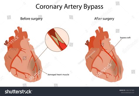 coronary artery bypass medical flat vector stock vector royalty