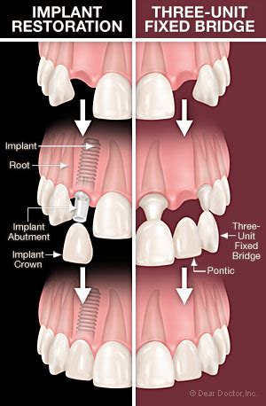 Dental Implants vs Fixed Bridges — Alliance Dental Center : Dentists in ...