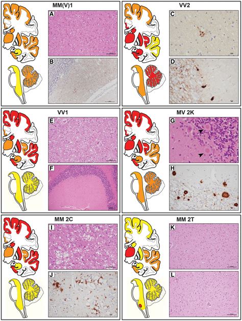 Lesion Profiles And Histopathological Hallmarks Of Sporadic Download Scientific Diagram