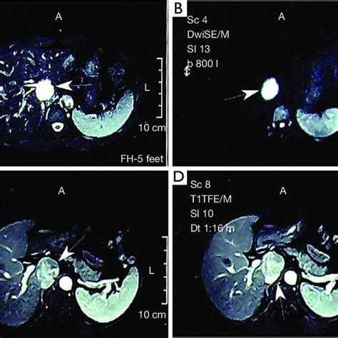 Liver Magnetic Resonance Imaging Scans T2 Weighted Image A Showed