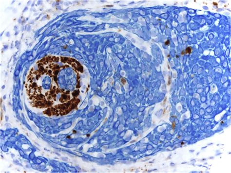 Multivariate Analysis Of Prognostic Factors In Primary Squamous Cell