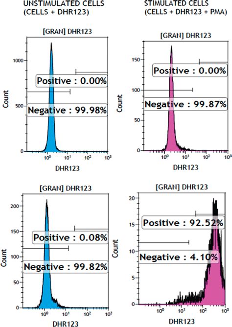 Chronic Granulomatous Disease With An Initial Presentation Of Arthritis