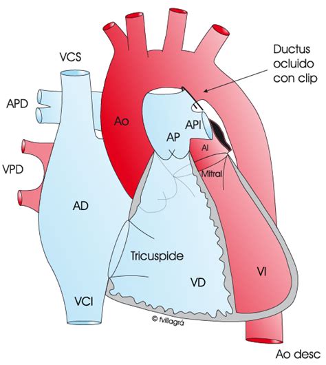 Ductus La web de las Cardiopatías Congénitas